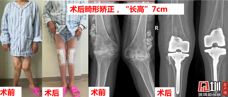 换膝术太神奇x型腿秒变细长直还原地长高7厘米