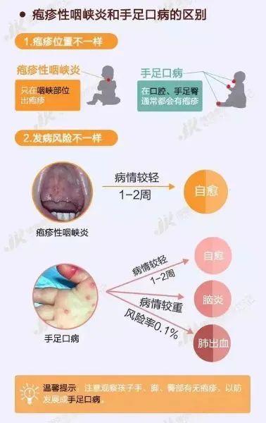 深圳新闻网首页 疱疹性咽峡炎全身和咽部症状体征一般在 1周 左右自愈