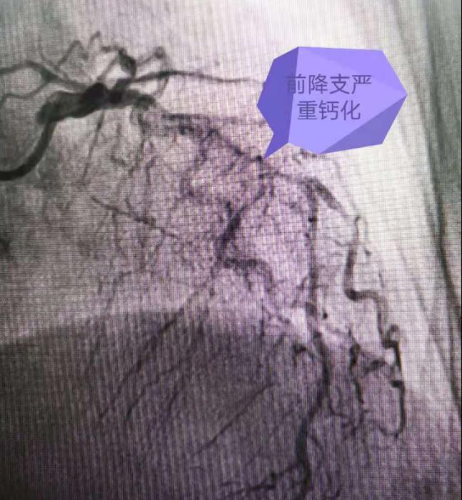 术中造影结果提示陈阿婆为冠脉三支病变,左主干斑块,前降支重度钙化