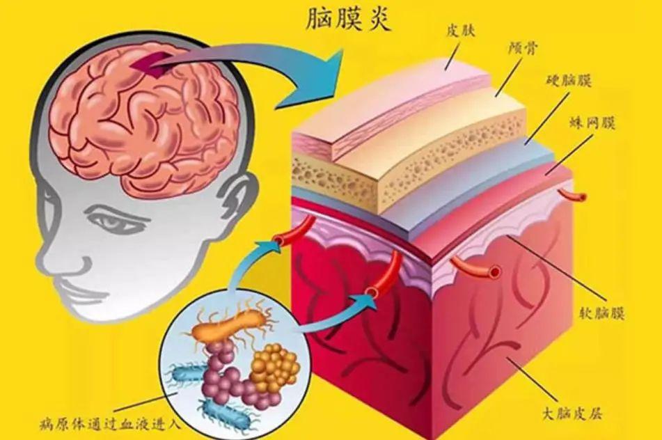 刚果(金)暴发脑膜炎疫情,报告疑似病例261例,死亡129例,病死率高达50%