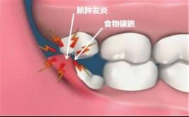 牙疼差点要命一颗智齿让孕妈差点失去八个月胎儿