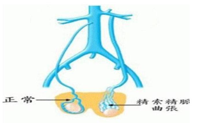 睾丸蚯蚓状血管图片图片