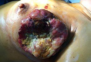 乳房肉瘤症状的图片图片