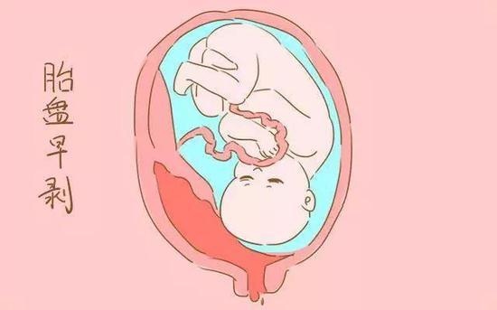 据了解,该名孕妇是瘢痕子宫,在羊水破裂之后,孕妇下体流出的血性羊水